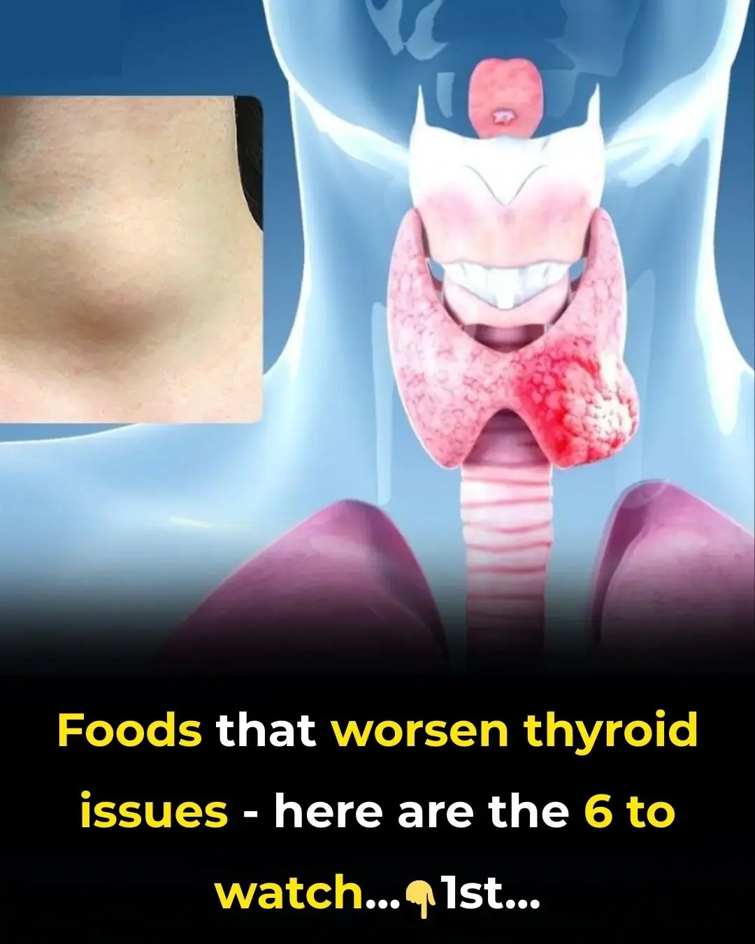 6 aliments que vous devez absolument éviter si vous souffrez d'un trouble thyroïdien